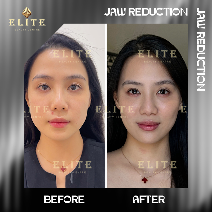 JAW REDUCTION